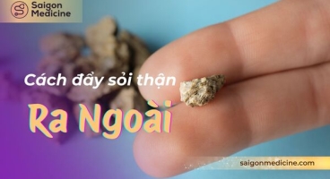 Cách Đẩy Sỏi Thận Ra Ngoài An Toàn: Giải Pháp Toàn Diện