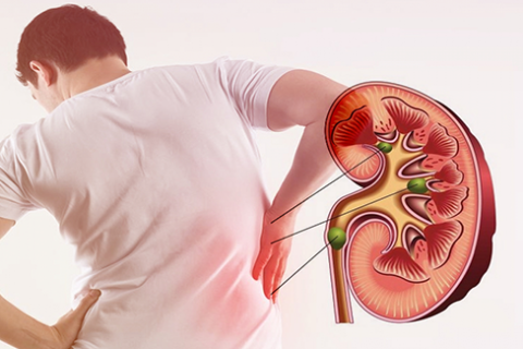 CƠN ĐAU QUẶN THẬN NGUY HIỂM RA SAO?