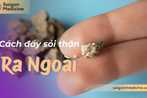 Cách Đẩy Sỏi Thận Ra Ngoài An Toàn: Giải Pháp Toàn Diện