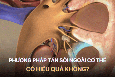 Tất Tần Tật Về Tán Sỏi Thận Ngoài Cơ Thể 