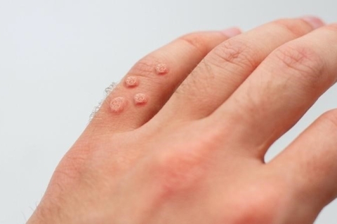 Một số lưu ý về sùi mào gà