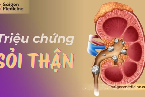 7 Triệu Chứng Sỏi Thận Thường Gặp: Nhận Biết Để Trị Bệnh