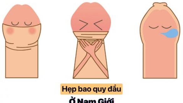 Hẹp Bao Quy Đầu: Nỗi Đau Thầm Kín Cánh Mày Râu