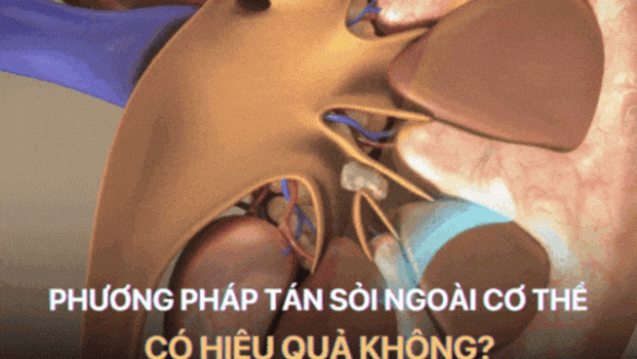 Tất Tần Tật Về Tán Sỏi Thận Ngoài Cơ Thể 