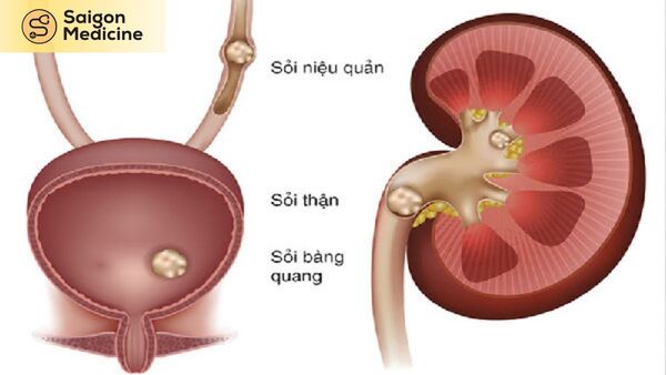 Đường đi chuyển của sỏi thận
