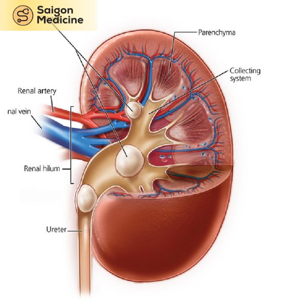 Sỏi thận đến từ 2 yếu tố nội tại và ngoại lai