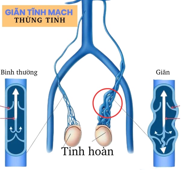 Mỗ giãn tĩnh mạch thừng tinh liệu có ảnh hưởng tới sinh sản