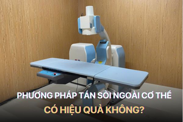 Phương pháp tán sỏi ngoài cơ thể liệu có hiệu quả