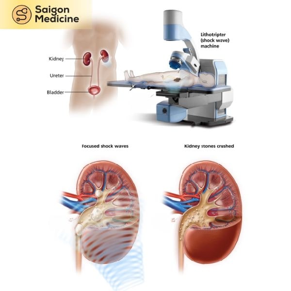 Phương pháp tán sỏi ngoài cơ thể (TSNCT)
