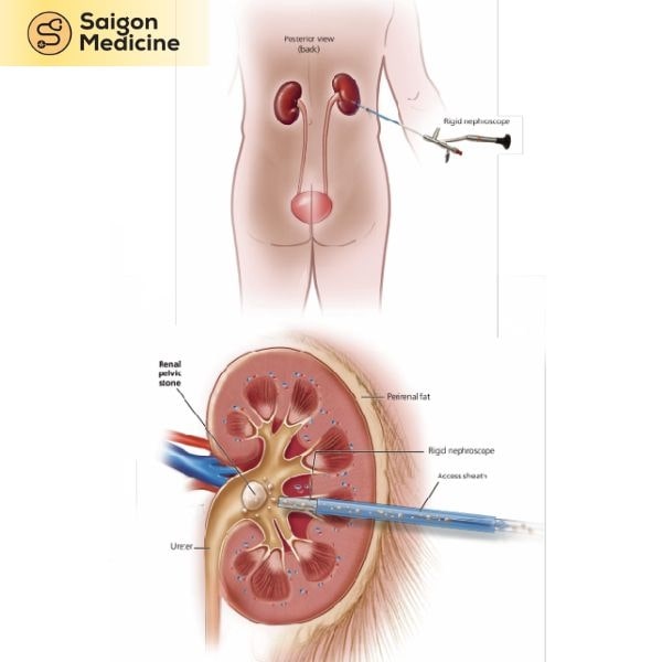 Phương pháp tán sỏi qua da