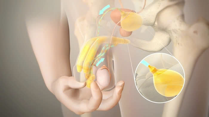 Đặt thể hang nhân tạo điều trị rối loạn cương dương